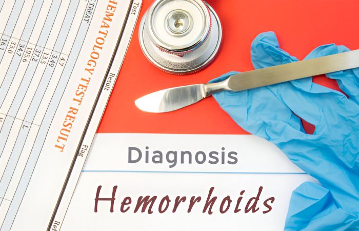 What are External Hemorrhoids_